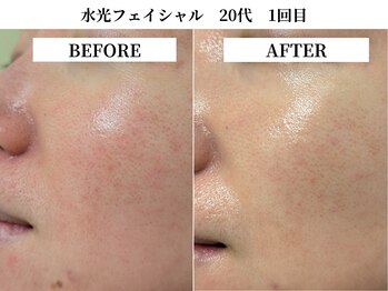 サンビ(SANBI)/赤み肌の原因は主に乾燥だった！