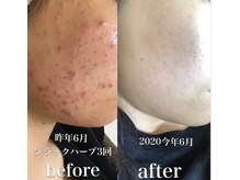 1回でも驚きの効果★ニキビケア/開き毛穴に効果抜群！