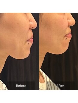 プライミー(PRIMY)/面長改善