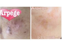 アルページュ(Arpege)/スポット集中シミケア＆水滴LDM