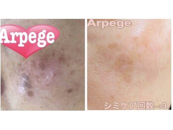 アルページュ(Arpege)/スポット集中シミケア＆水滴LDM