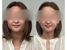彩葉 結び(イロハ)の雰囲気（小顔フェイシャル）