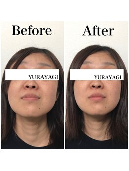 小顔屋ゆらやぎ/頭蓋骨小顔矯正レタッチフェイス