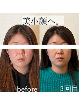 ノア(NOA)/ビフォーアフター