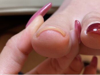 カリネイル(Calli nail)の写真/【爪のお悩み解消◎】巻き爪・歩くと爪や足の指が痛い方の救世主サロン☆あなたのお悩み根本改善♪