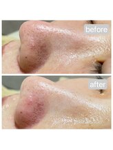 トランク(Trunk)/ハイドラ♪before→after