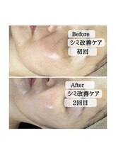 ル ボヌール 伊那店(le bonheur)/シミケア・・・2回目にして！？