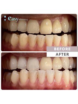 イージーホワイトニング 五反田店(easy whitening)/セルフホワイトニング症例写真