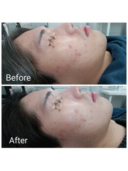 レン(Ren)/ラテスパ〈毛穴洗浄〉/メンズ