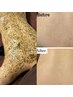 人気NO.3【背中の肌荒れケア】前撮り・挙式前に☆REVIハーブピーリング