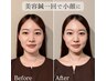 【美容鍼モニター】目隠しなし掲載可の方！小顔×首コリ改善60分￥11000→