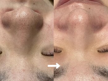 ヴィセラ(Vicella)の写真/韓国美容サロン発！毛穴洗浄で驚くほどツルツル肌へ☆