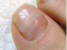 ■巻爪矯せい■