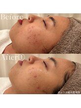 オムリス鍼灸接骨院/before after/ハーブピーリング