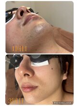 エリシオン(ELYSION)/部分脱毛