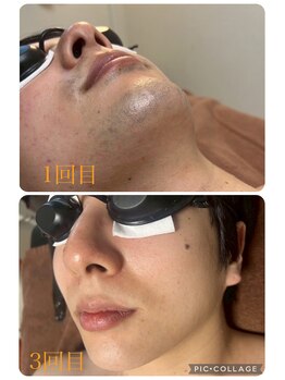 エリシオン(ELYSION)/部分脱毛