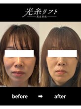 ヘルディン(heldin +555)/光糸リフトbefore→after