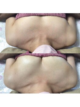 マイントゥー(mine too)/バストアップ症例