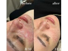 #美容革命ラボ 福岡春吉店/肌経過【春吉・天神・博多】