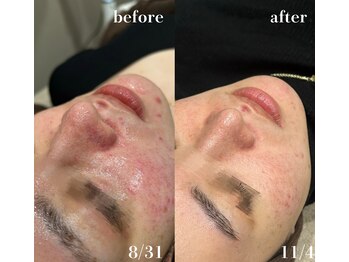 #美容革命ラボ 福岡春吉店/肌経過【春吉・天神・博多】