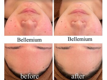 ベレミアム(Bellemium)/赤み改善