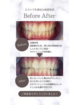 エクシアホワイト 平岸駅前店/ホワイトニング☆口コミのご紹介