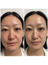 リクラ 北千住(Reclat)/1回で小顔、艶肌、むくみ◎