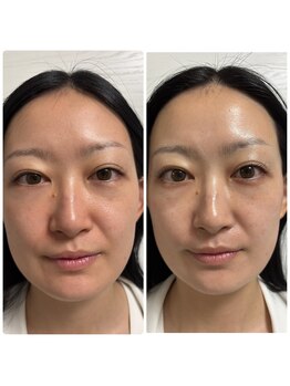 リクラ 北千住(Reclat)/1回で小顔、艶肌、むくみ◎