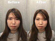くにたちNyan鍼灸整体院/【小顔矯正】Before After 2