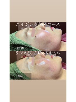 マリー(Mary.)/エイジングケアコース