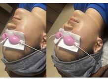 ベル(Belle+vi)/小顔に♪光フェイシャル