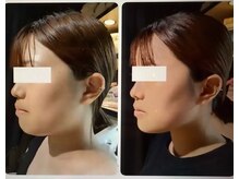 セントセシリア/レモンボトル顎下首元すっきり♪