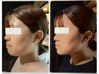 セントセシリア/レモンボトル顎下首元すっきり♪