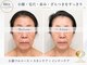 ココ(COCO)の写真/《渡韓と迷う方！》サーマクールリフトでターンオーバーの乱れを整え、ハリツヤUPエイジングを実感◎