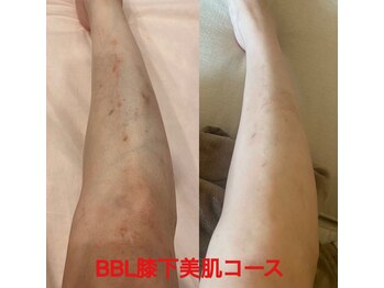 ちゅるん肌ドットコム 石橋店(ちゅるん肌.com)/BBLひざ下美肌フォト￥4,950