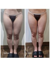 ラクト サロン(RAKT salon)/脂肪冷却２カップ　内もも