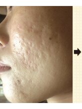 ノットノット 自由が丘(Not Knot)/１.グリーンピール 5days 施術前