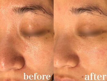 サロン ラズリ 久留米店(SALON Lazuli)/【毛穴洗浄】ハリツヤが欲しい！