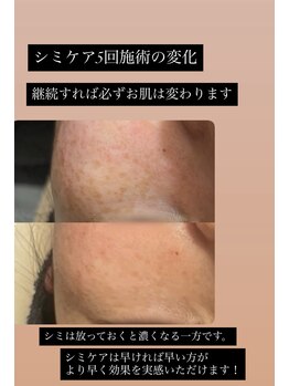 リノ(Lino)/シミケア5回施術後