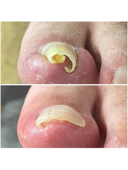 チェンジ(CHANGE)/巻き爪