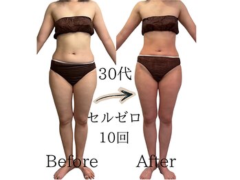 ニコ(nico)/nico/セルライトゼロ/痩身