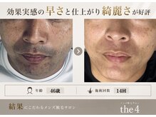 フォー(the 4)の雰囲気(青ヒゲと肌荒れを卒業すれば清潔感が変わる♪)