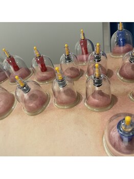 リ シャルム(Re Charme)/カッピング施術