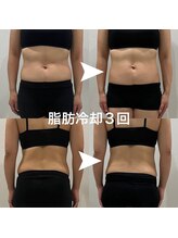 アンドアップ(and up)/【痩身】脂肪冷却