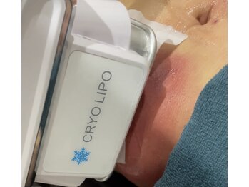 アグライア(Aglaea)/脂肪冷却/術後