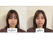 ヤマモト 表参道院(YAMAMOTO)/美容鍼＋筋膜調整＋ヘッドスパ