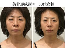 ドクターボディクリスタル(Dr.Body Crystal)の雰囲気(【リフトアップ/頬骨の出っ張り/ほうれい線】一度でこの変化!)