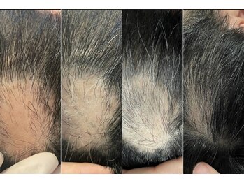 ジェルブラローズ(gerbera rose)/育毛促進before/after