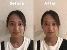 くにたちNyan鍼灸整体院/【小顔矯正】Before After 3