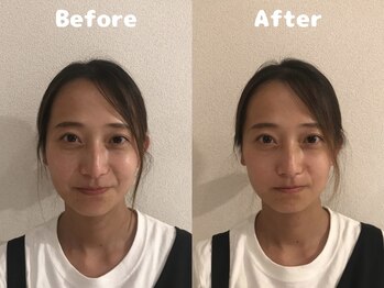 くにたちNyan鍼灸整体院/【小顔矯正】Before After 3